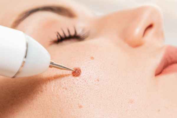 CryoPen: 5 Skin Concerns It May Be Used to Treat 3 What actually happens during a CryoPen treatment Newport?